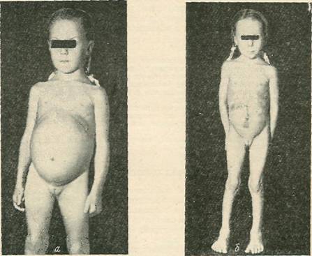 Девочка (6 лет) с непаразитарной кистой печени, до и после операции