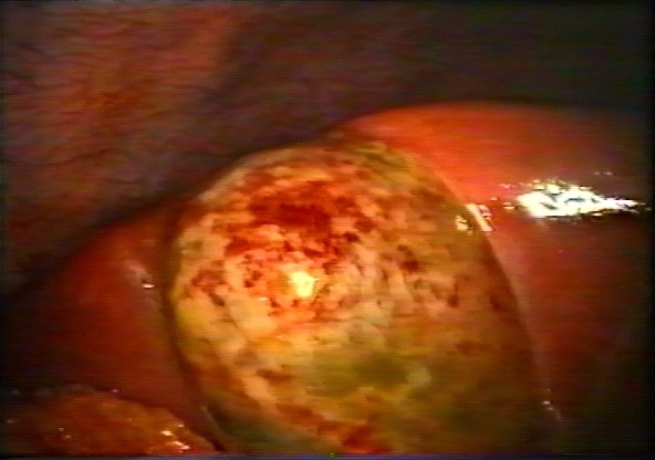 Интраоперационный снимок желчного пузыря при остром холецистите