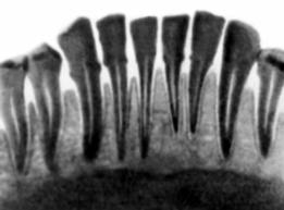 Внутриротовая рентгенограмма зубов нижней челюсти при пародонтозе