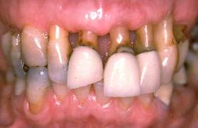 Поражение зубов при пародонтозе