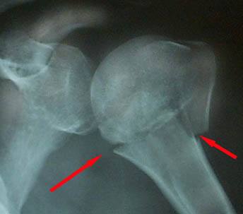 Перелом плечевой кости (рентгенограмма)