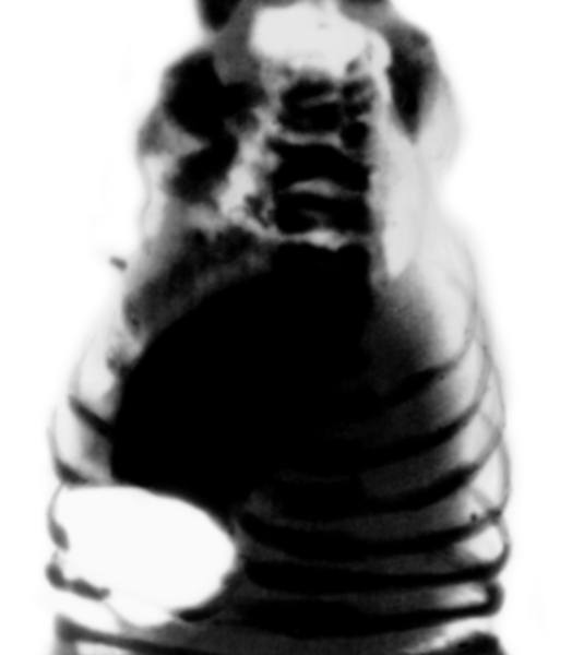 Рентгенограмма органов брюшной полости при пилоростенозе