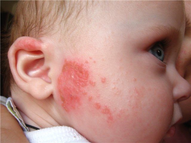 Мкб код аллергия у детей thumbnail