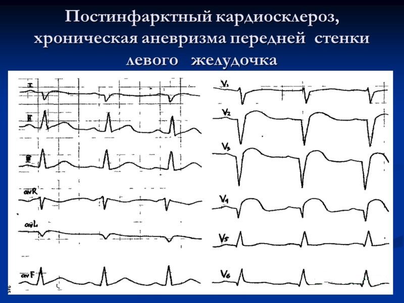 Код мкб постинфарктный кардиосклероз thumbnail