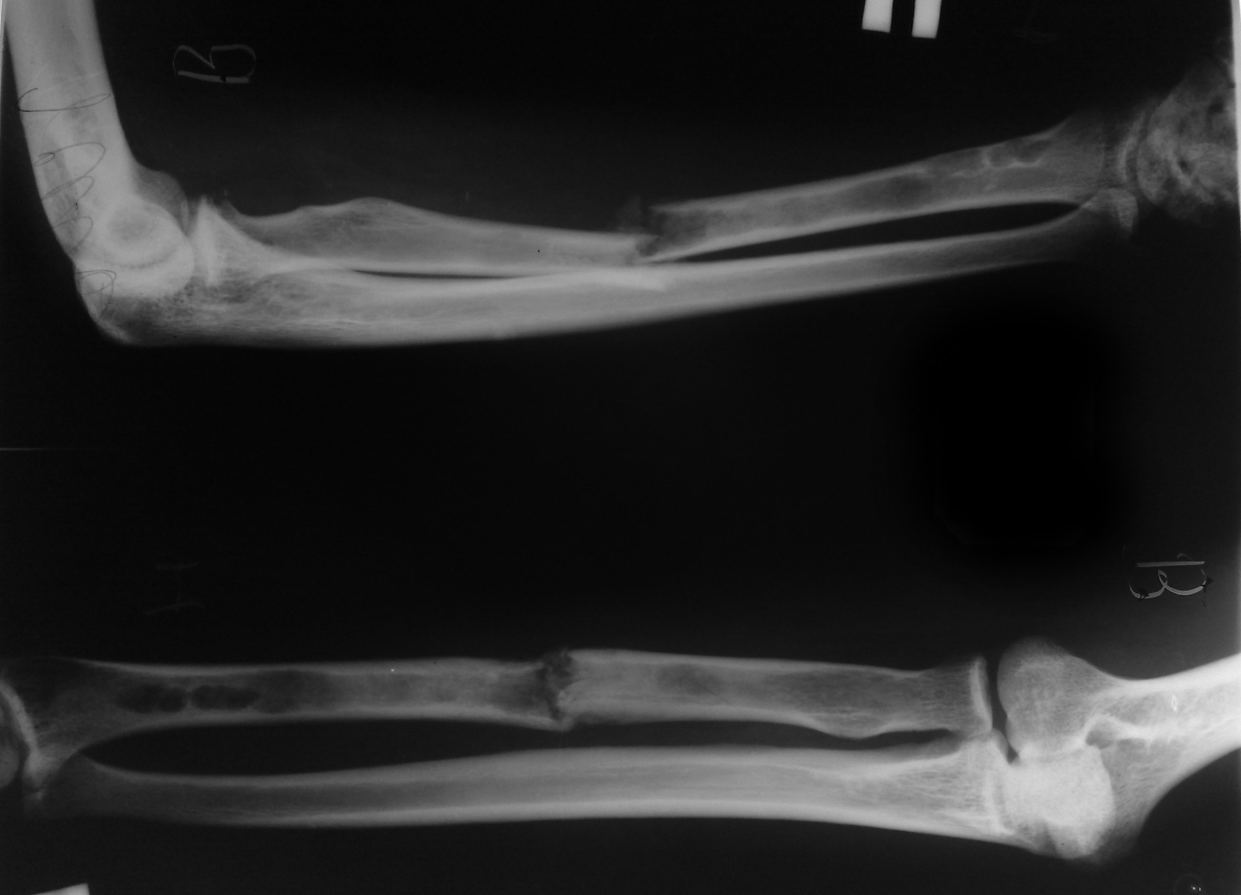 Патологический перелом лучевой кости после биопсии