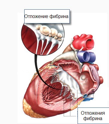 Ревматическая болезнь сердца код мкб thumbnail