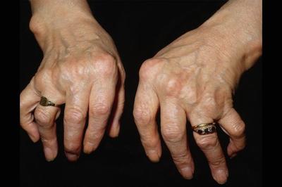 Ревматоидный артрит код болезни thumbnail