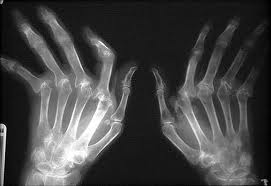 Мкб 10 коды болезней ревматоидный артрит thumbnail