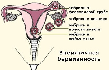Различные варианты локализации эмбриона при внематочной беременности