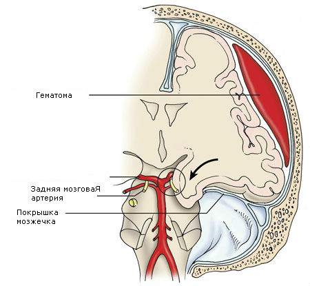 Сдавление головного мозга гематомой