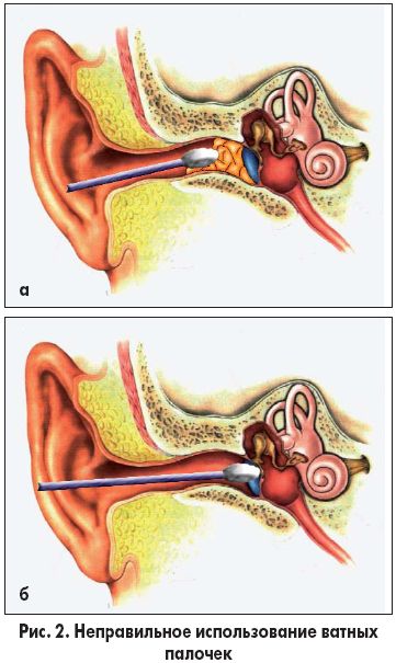 Серная пробка уха по коду мкб 10 thumbnail