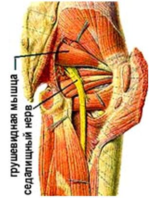 Синдром грушевидной мышцы код мкб thumbnail