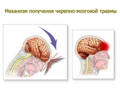 Механизм возникновения черепно-мозговой травмы
