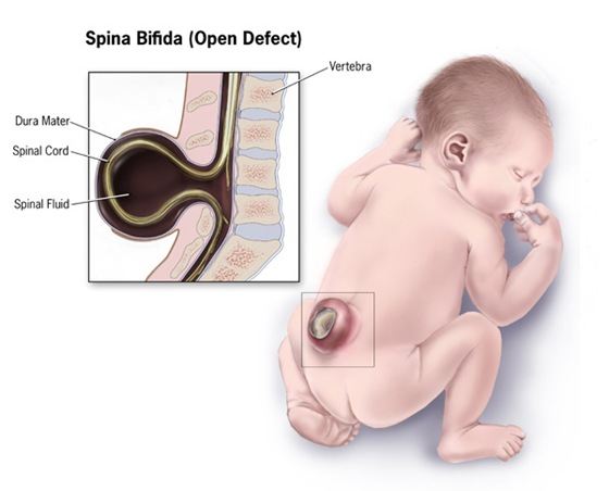 Код мкб spina bifida thumbnail