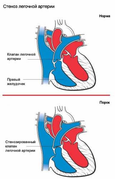 Код мкб стеноз легочной артерии thumbnail