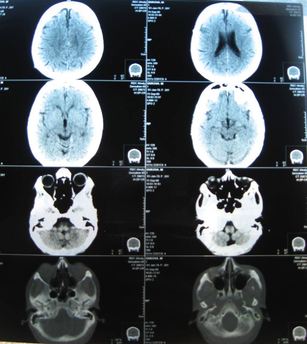 Энцефалопатия на КТ головного мозга