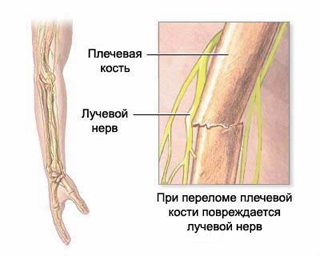 Повреждение лучевого нерва (неврит лучевого нерва) в месте перелома плечевой кости.