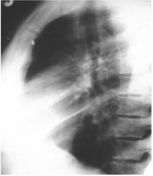 Рентгенограмма больного туберкулезным плевритом