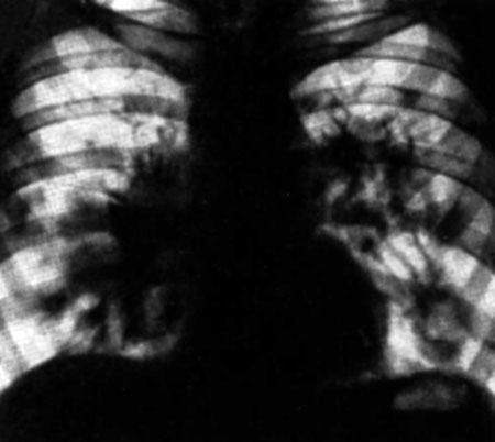 Двухсторонняя вирусная пневмония на обзорной рентгенограмме