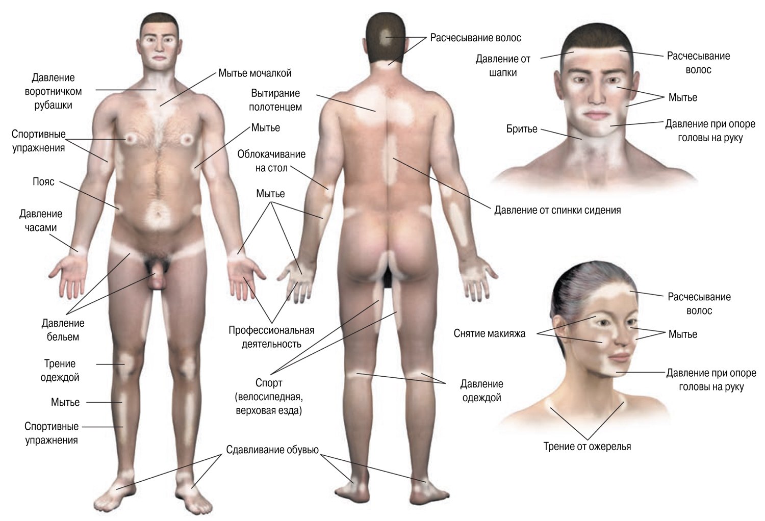 Появление пятен витилиго в ответ на трение или давление на кожу