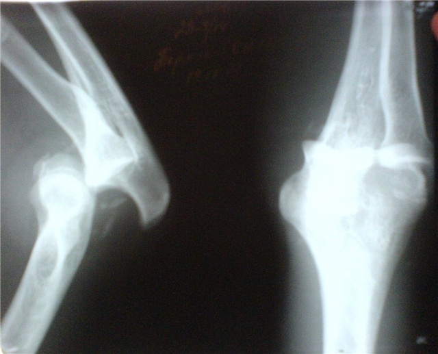 Вывих локтевого сустава (рентгенограмма)