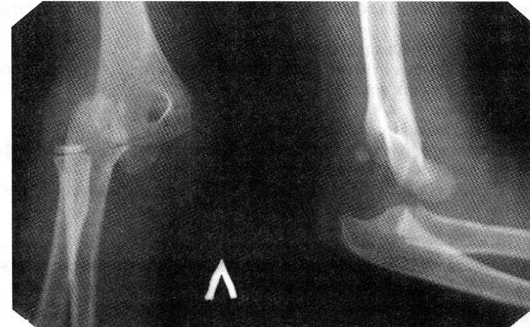 Вывих костей предплечья (рентгенограмма)