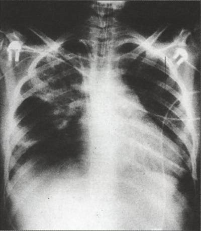 Рентгенграмма ребенка с внутриутробной пневмонией