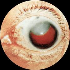 Врожденная катаракта при осмотре глазного дна
