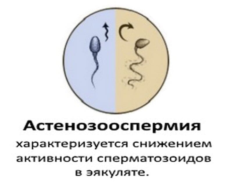 Классификация степеней астенозооспермии
