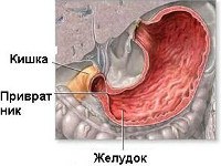 K31.1 Гипертрофический пилоростеноз у взрослых