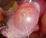 Borderline ovarian tumors