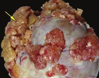 Borderline ovarian tumors