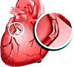 I25 Хроническая ишемическая болезнь сердца