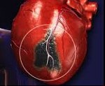 I21 Острый инфаркт миокарда
