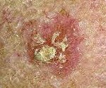 Squamous cell skin cancer