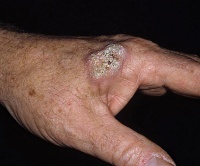 Squamous cell skin cancer