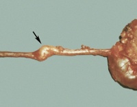 C66 Malignant neoplasm of ureter