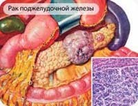 C25 Malignant neoplasm of pancreas