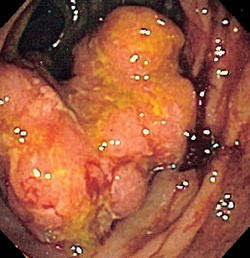 C20 Malignant neoplasm of rectum