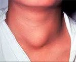 C73 Злокачественное новообразование щитовидной железы