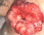 C51 Malignant neoplasm of vulva