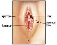 C51 Malignant neoplasm of vulva