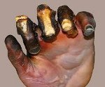 Термические и химические ожоги наружных поверхностей тела thumbnail