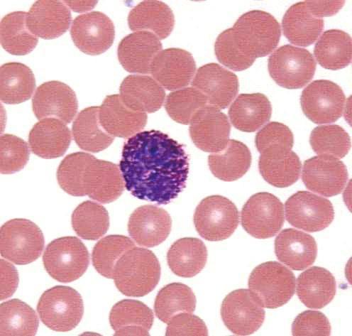 Клетки с гиперхромными ядрами. Гиперхромная анемия мазок крови. Базофил гистология препарат. Базофил в микроскопе. Базофилы в мазке крови.