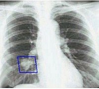 Central lung cancer