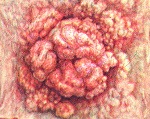 Villous tumor of the colon