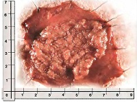 Villous tumor of the colon