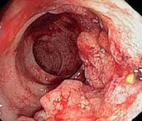 C18 Malignant neoplasm of colon