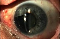 Melanoma of the eye