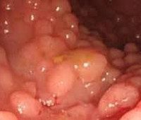 Familial polyposis of the colon